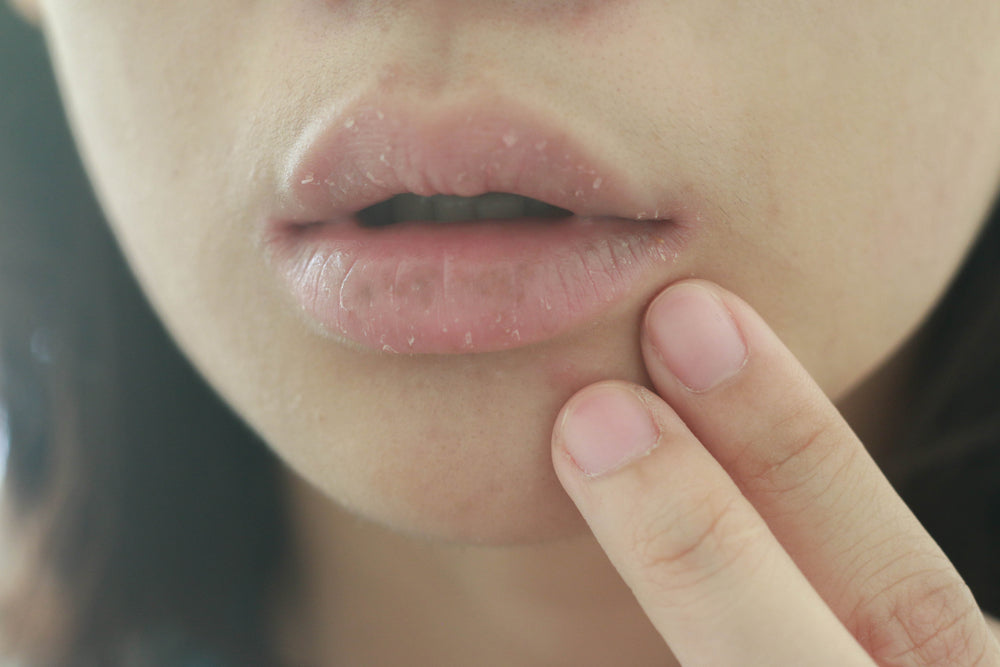 Managing Dry and Chapped Lips