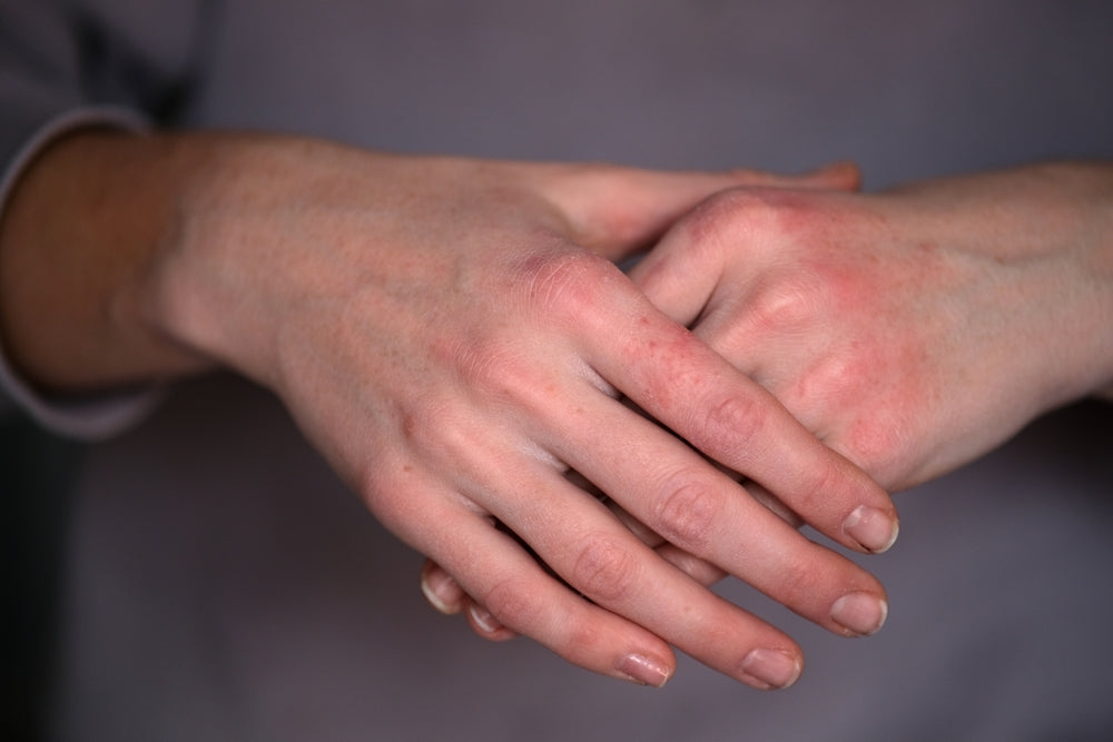Seasonal Eczema Challenges: Chapped and sore hands